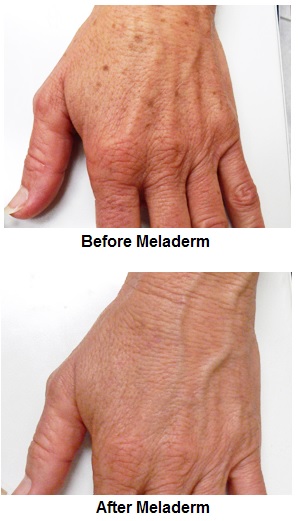 before and after using Meladerm on liver spots