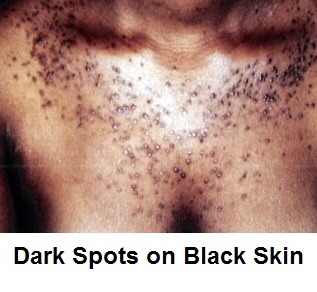 Dark Spots On Black Skin