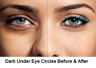 Dark Under Eye Circles Before And After