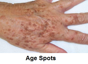 Age Spots - image