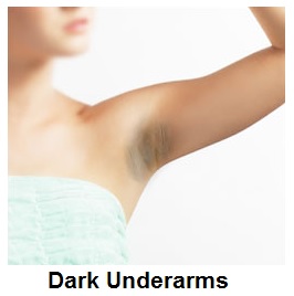 Dark Underarms - image