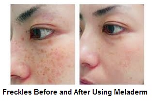 Freckles before and after using Meladerm