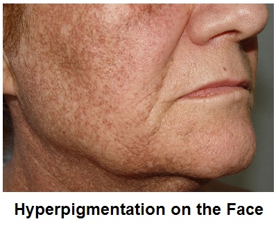 hyperpigmentation on the face