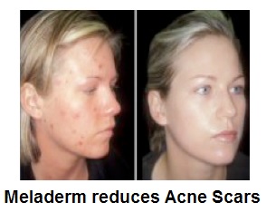 Meladerm reduces acne scars